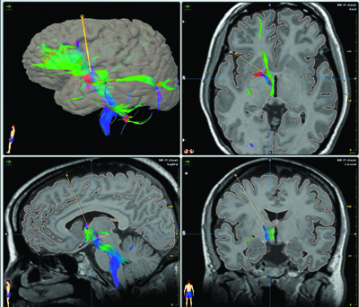 inferior thalamic peduncle