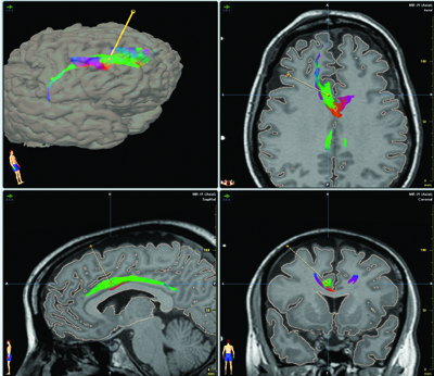 Rostral Cingulate cortex